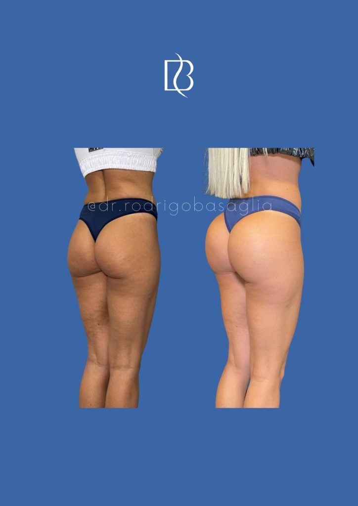 Bioplastia-de-gluteos_page-0002