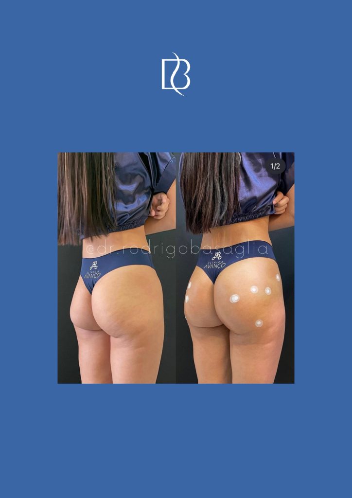 Bioplastia-de-gluteos_page-0003