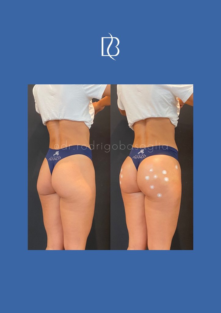 Bioplastia-de-gluteos_page-0004