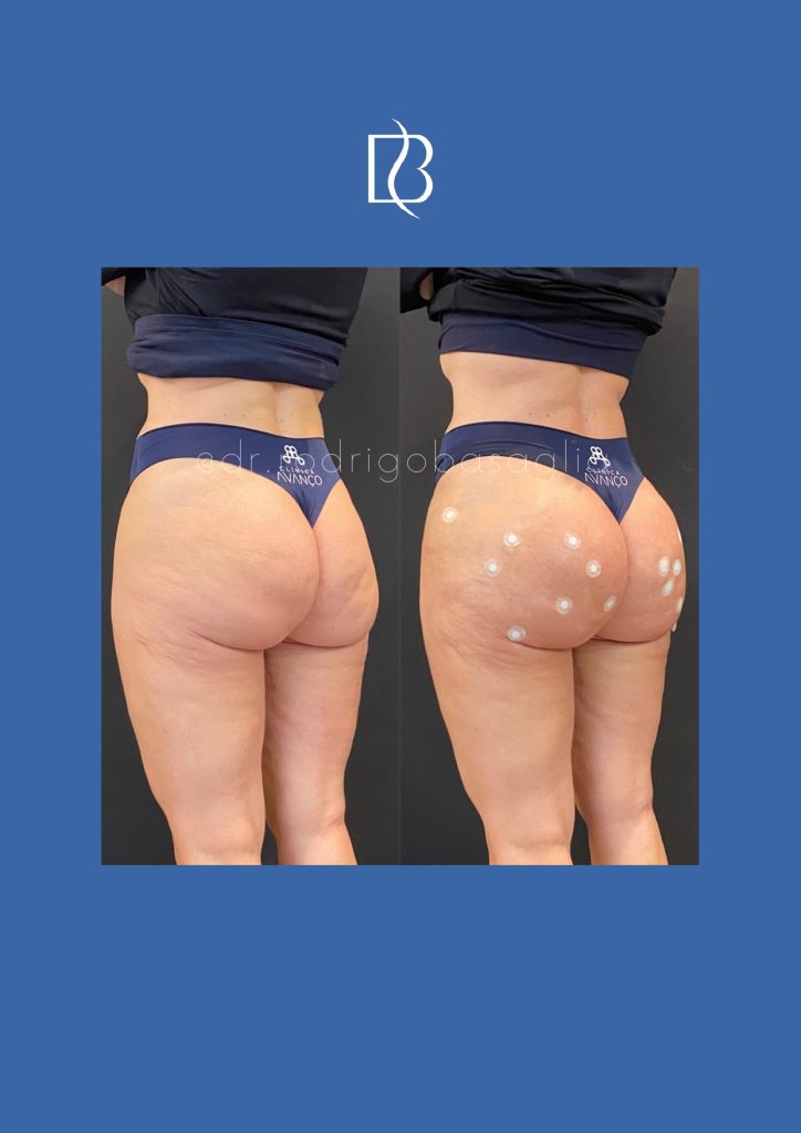 Bioplastia-de-gluteos_page-0005