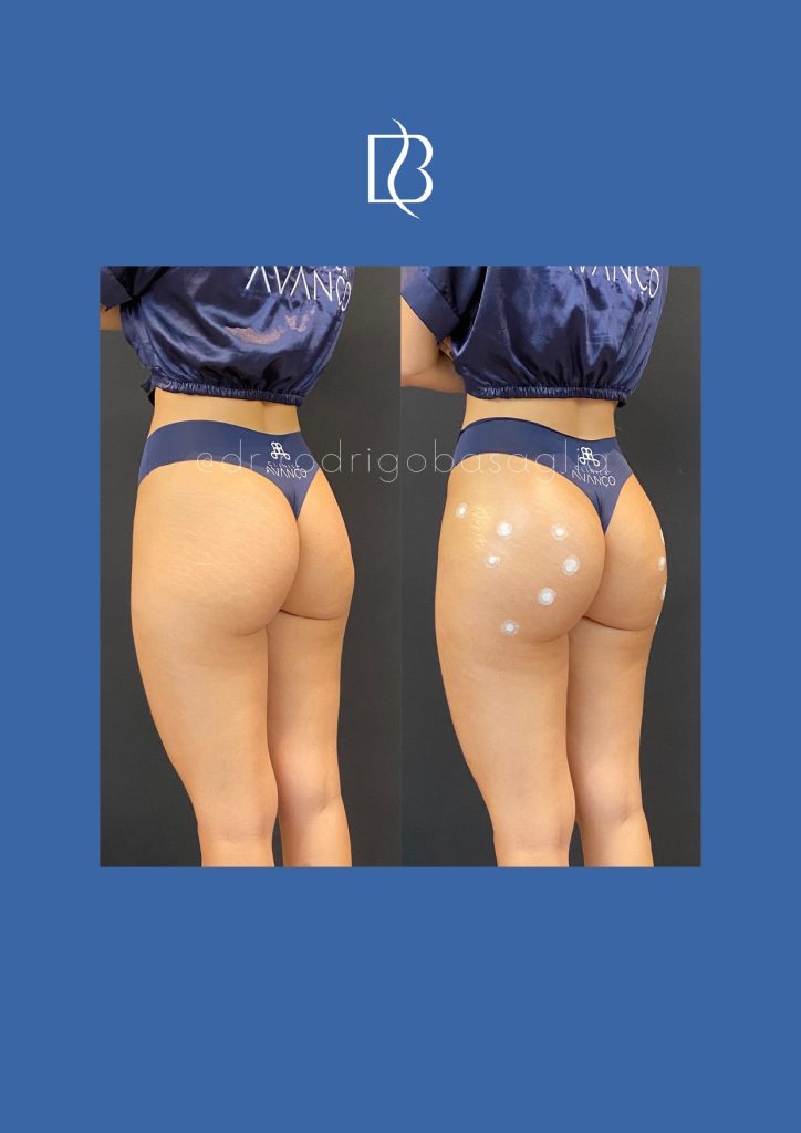 Bioplastia-de-gluteos_page-0006