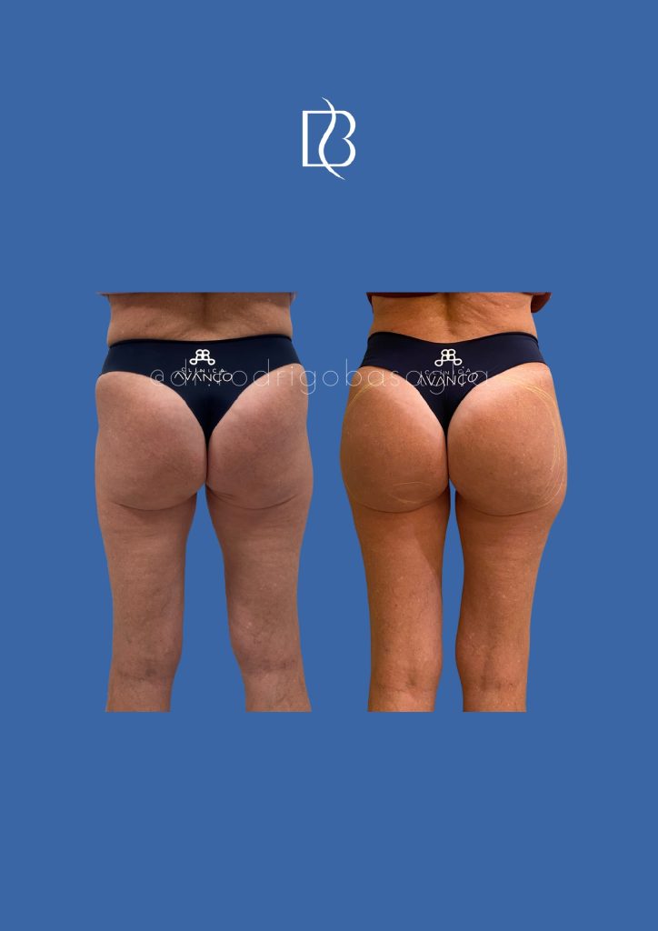 Bioplastia-de-gluteos_page-0007