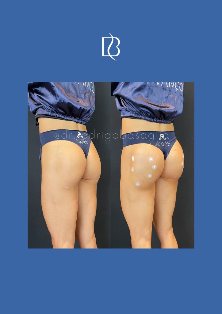 Bioplastia-de-gluteos_page-0008