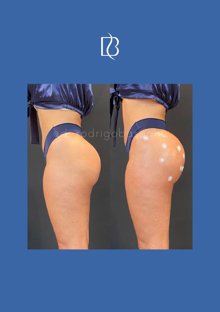 Bioplastia-de-gluteos_page-0009