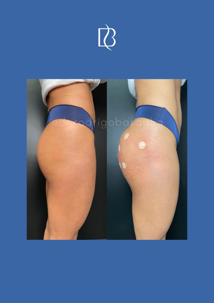 Bioplastia-de-gluteos_page-0010