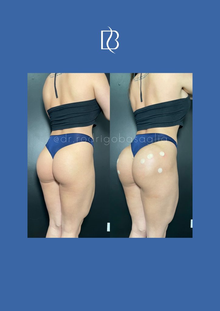 Bioplastia-de-gluteos_page-0012
