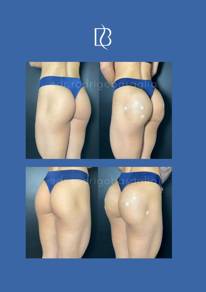 Bioplastia-de-gluteos_page-0013