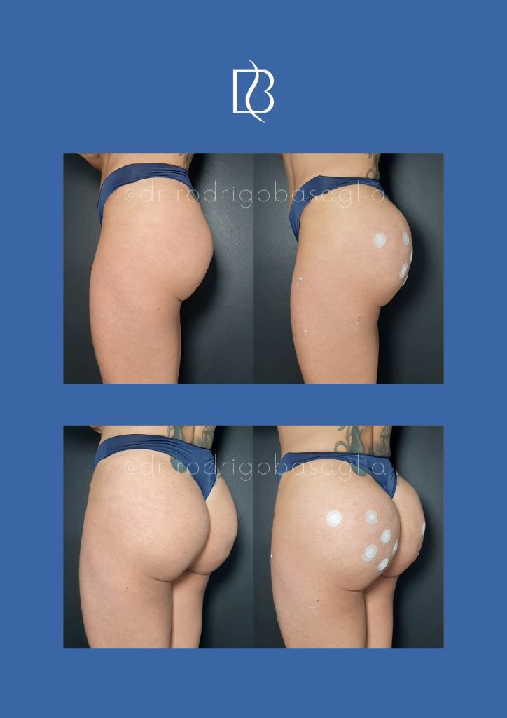 Bioplastia-de-gluteos_page-0014