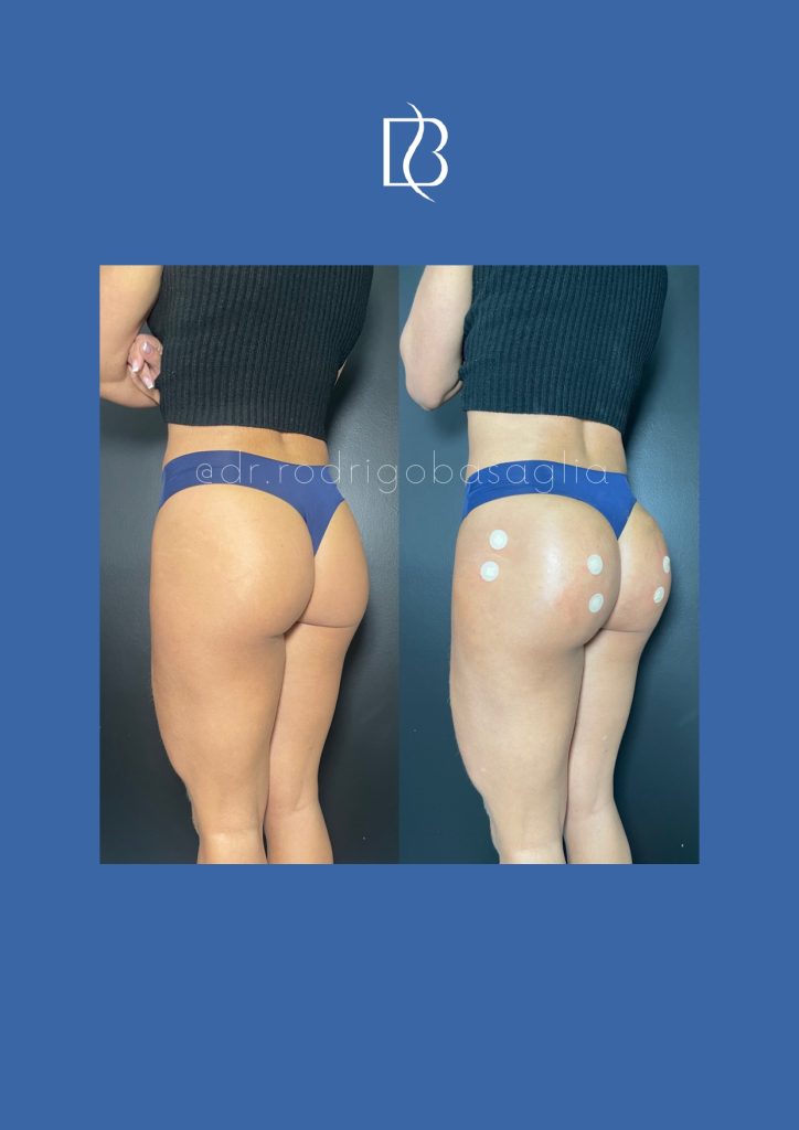 Bioplastia-de-gluteos_page-0015