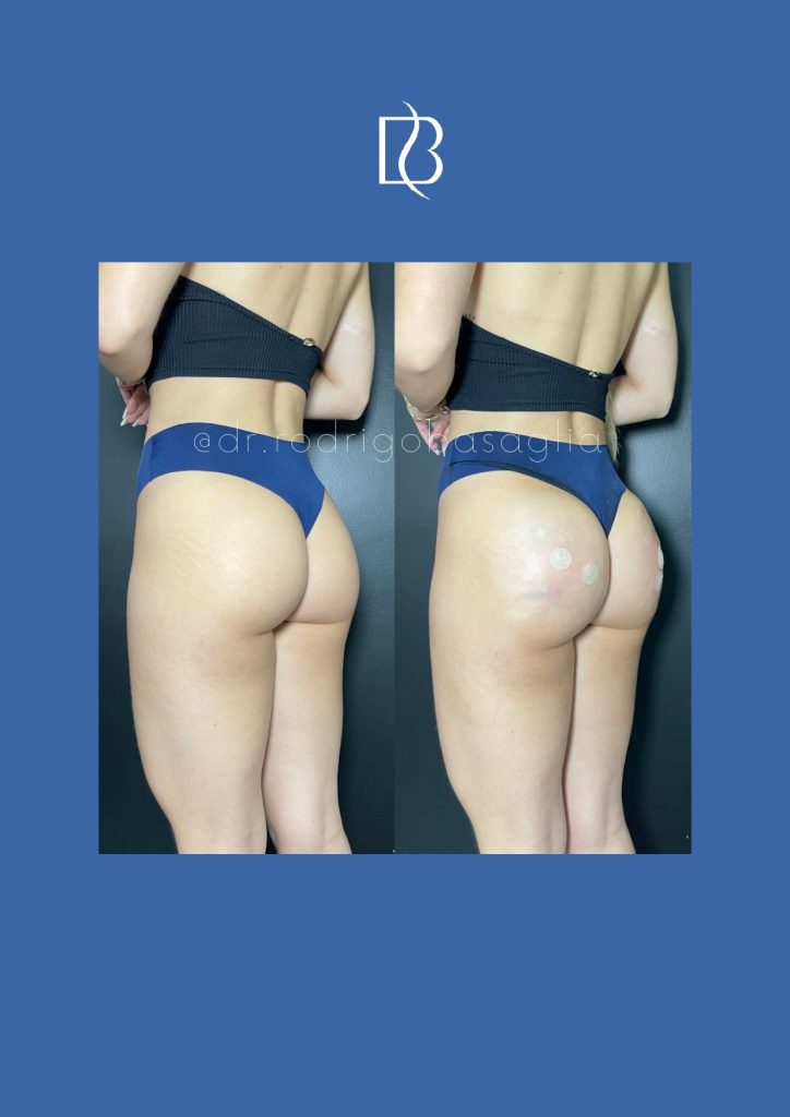 Bioplastia-de-gluteos_page-0016