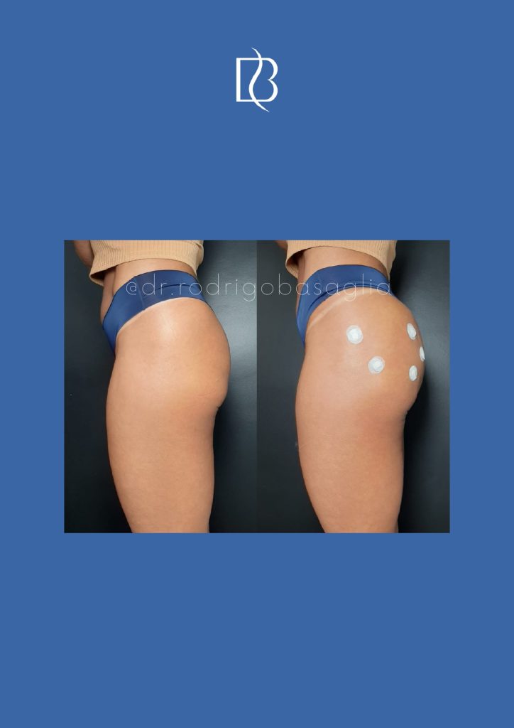Bioplastia-de-gluteos_page-0017