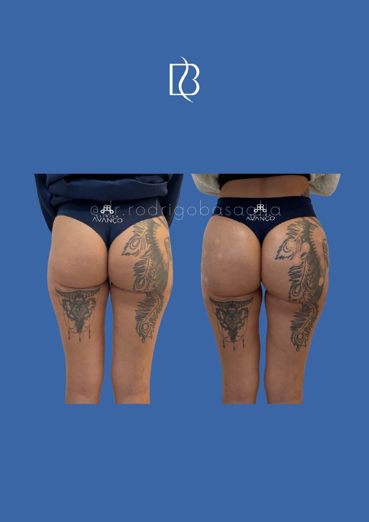 Bioplastia-de-gluteos_page-0018