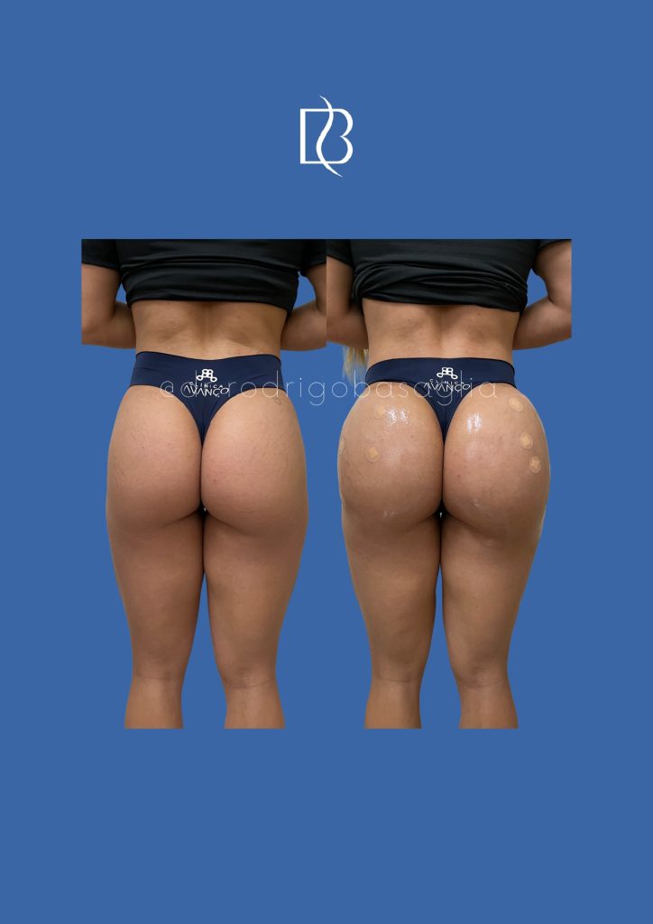 Bioplastia-de-gluteos_page-0020