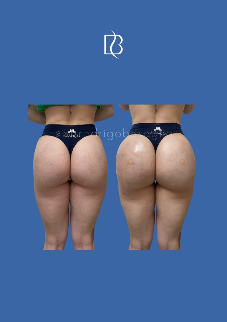 Bioplastia-de-gluteos_page-0021