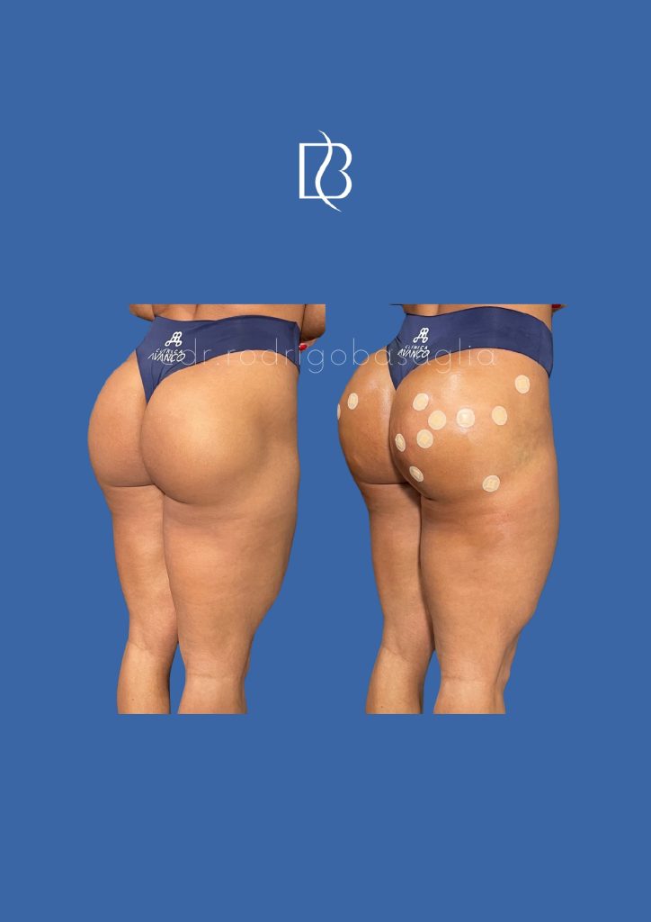 Bioplastia-de-gluteos_page-0022