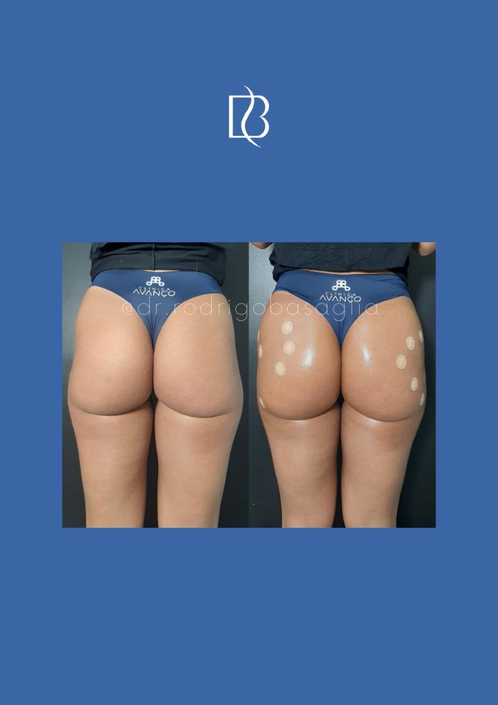Bioplastia-de-gluteos_page-0023