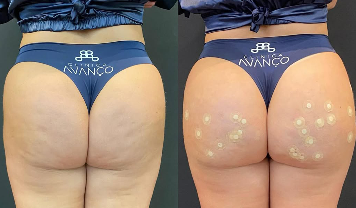 harmonização glútea